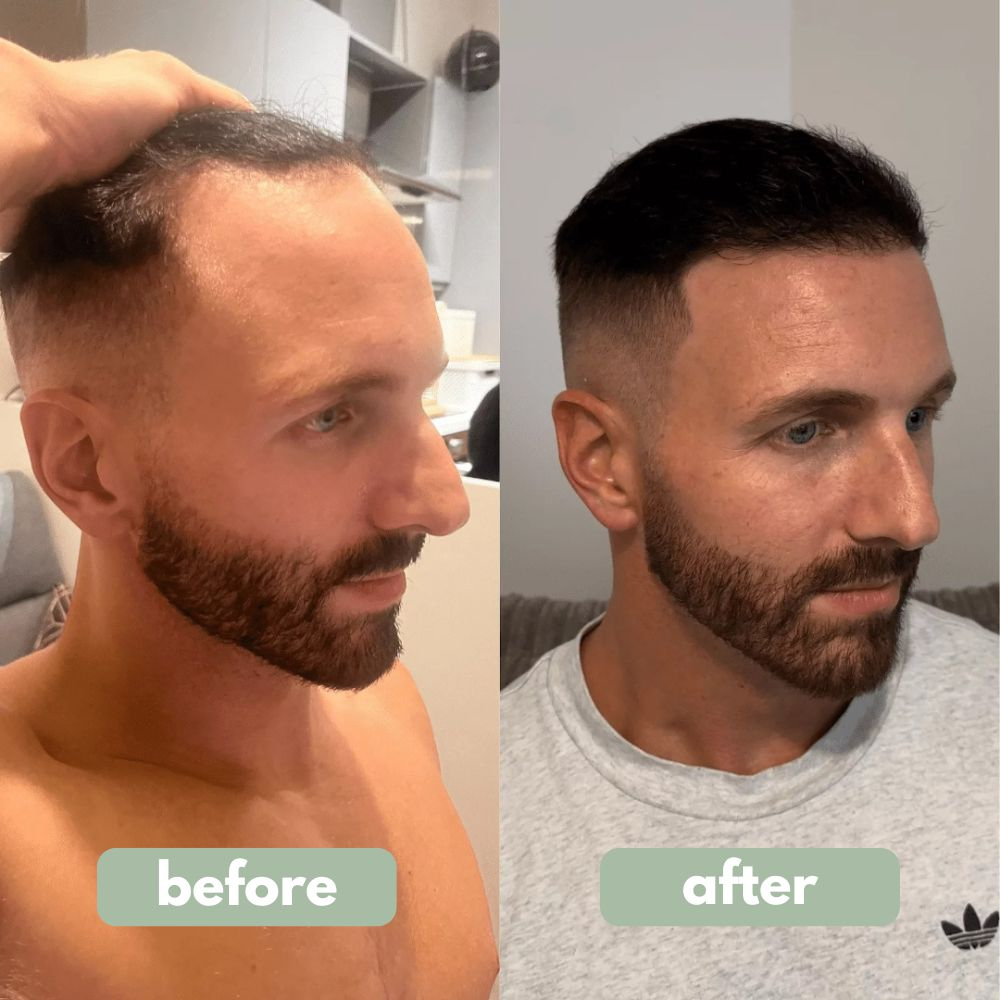 New Hair Growth Serum Roll-On With Redensyl