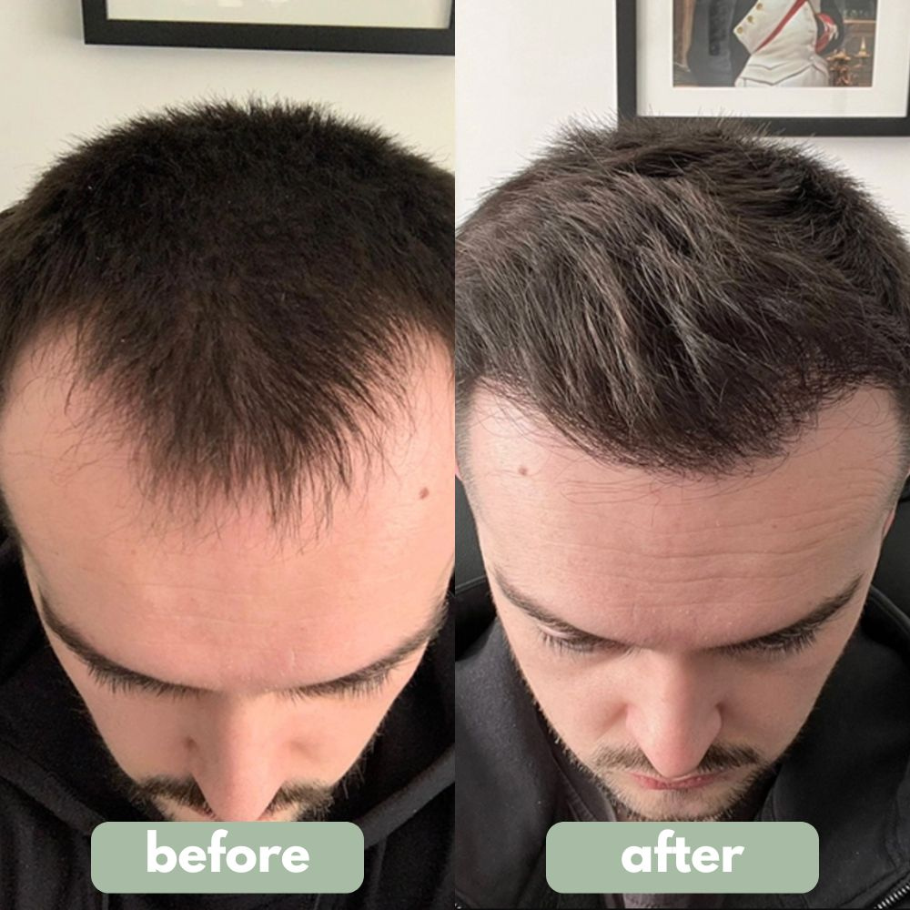 New Hair Growth Serum Roll-On With Redensyl